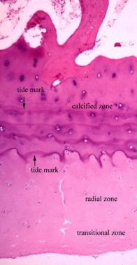 Periosteal bone formation on the surface of cortic