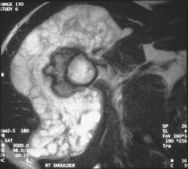 Axial T2-weighted MRI of a periosteal chondrosarco