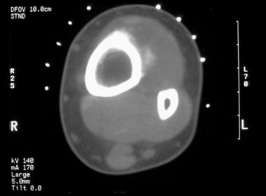 CT scan of the periosteal osteosarcoma seen in the