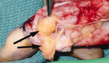 Intraoperative photograph shows lipofibromatous ha