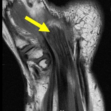 Coronal T1-weighted image of 40-year-old woman who