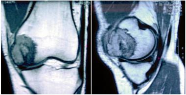 Original MRI of a patient demonstrating a lesion e