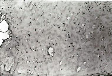 Histology of original lesion demonstrating what wa