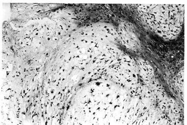 Recurrent tumor demonstrating progression from a p