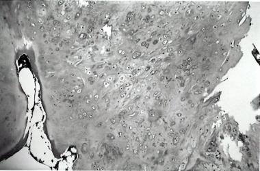 Tumor from pin sites revealing a well-differentiat