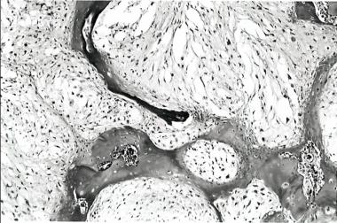 Histology at time of recurrence showing progressio