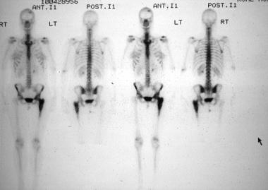 Total skeleton technetium-99m (99mTc) nuclear medi