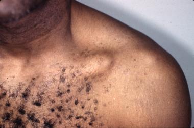 Clinical photo of a left shoulder shows a prominen
