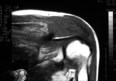 Coronal, T1-weighted magnetic resonance imaging (M