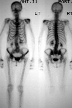 Total skeleton technetium-99m (99mTc) nuclear medi