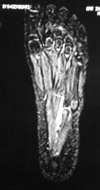 MRI in the same patient as in image above shows al