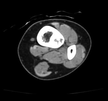 Reconstructed axial CT scan shows osteoid osteoma.