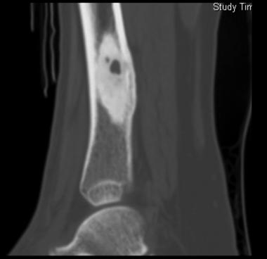 Sagittal CT scan shows osteoid osteoma. Courtesy o