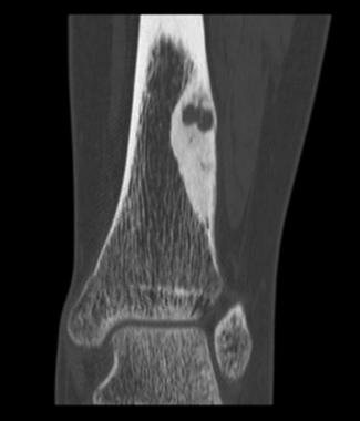 Coronal CT scan shows osteoid osteoma. Courtesy of