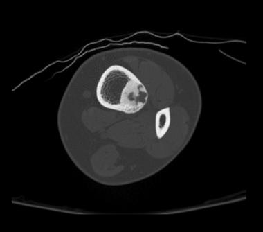 Axial CT scan shows osteoid osteoma. Courtesy of C