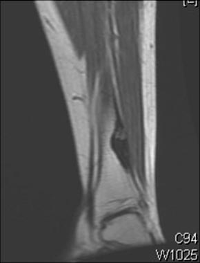 MRI shows osteoid osteoma. Courtesy of Cincinnati 