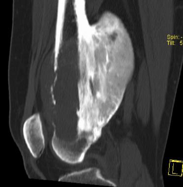 CT Sagittal Reconstruction of the same lesion as i