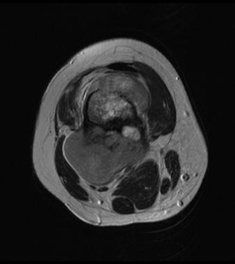 T2 weighted MRI axial section of the same lesion s