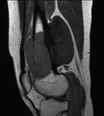 T1 weighted MRI scan of the same lesion as in plai