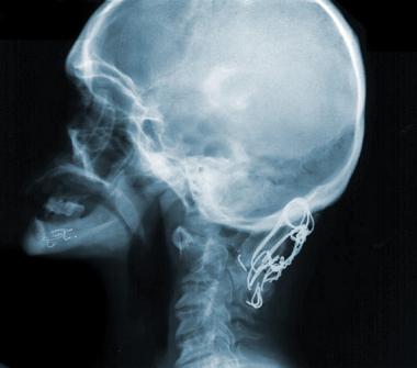 Lateral cervical radiograph in a female with Down 