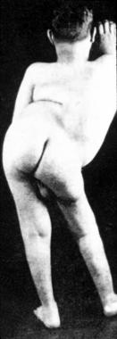 A patient with severe, congenital hyperlordosis. 