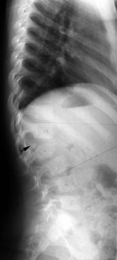 Congenital kyphosis from a posterior, unbalanced h