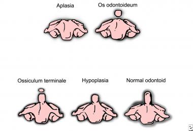 Gradations of the odontoid process's appearance. 