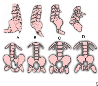 Sacral agenesis classification. A: type I. B: type