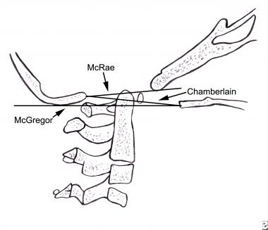 Lateral craniotomy. The drawing indicates the 3 li