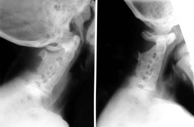 Klippel-Feil syndrome with congenital fusion of th