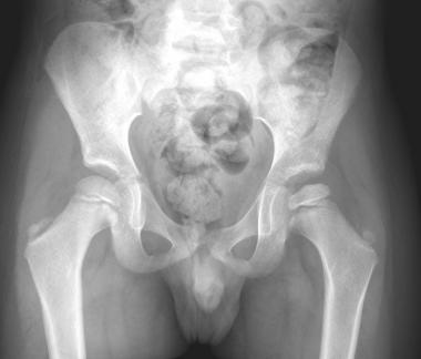 A 5-year-old boy with Legg-Calve-Perthes Disease. 