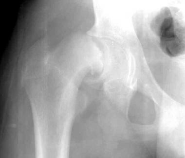 Slipped capital femoral epiphysis. 