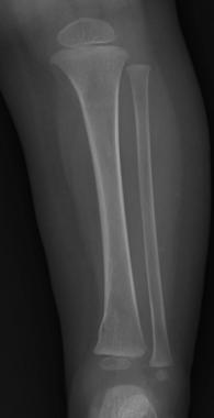 A 10-month-old boy with left distal tibia buckle f