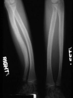 Radial and ulnar bowing and obliteration of intram