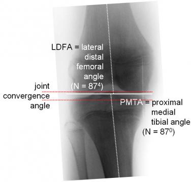 Anatomic angles are measured between joint surface