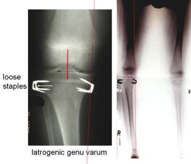 Full-length view shows mechanical axis deviation i