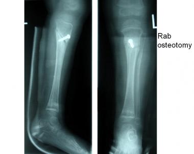 Patient underwent corrective osteotomy of upper ti