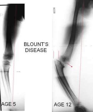 Tibia vara (Blount disease) is growth disturbance 