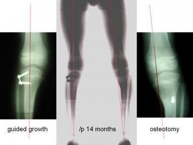 At 14-month follow-up, mechanical axis is neutral 