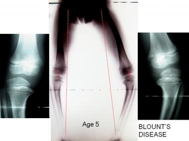 At age 5, this boy presented with asymmetrical tib