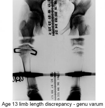 At 1 year after proximal tibial stapling to correc