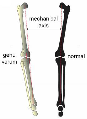 Mechanical axis is measured on full-length weightb