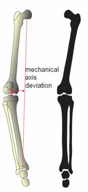 Three factors contributing to genu varum: varus fe
