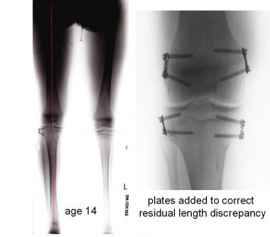 At 1 year after guided growth with eight-Plate, me