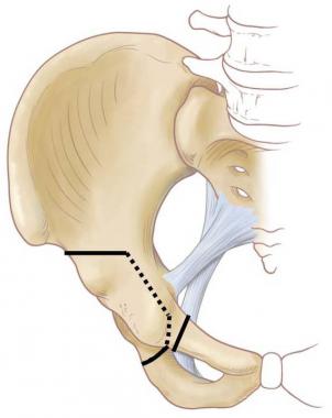 Anterior view of pelvis demonstrating lines of Gan