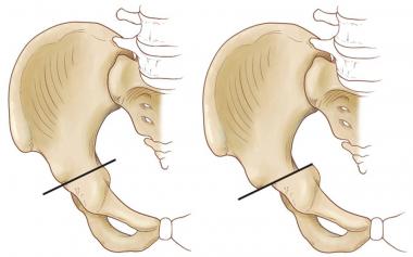 Chiari Osteotomy 