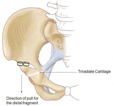 Dega Osteotomy 