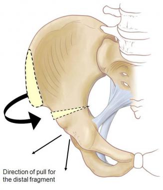 Salter Innominate Osteotomy: Distal fragment is pu