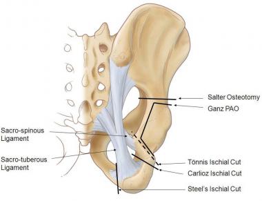 Posterior view of pelvis demonstrating lines of va