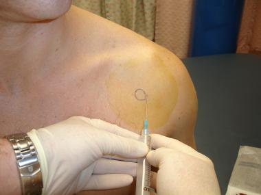 Shoulder arthrocentesis. Insert needle medial to h